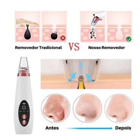 Removedor De Cravos Espinhas Cleaning Sugador Poros Acne Sucção Usb Recarregável
